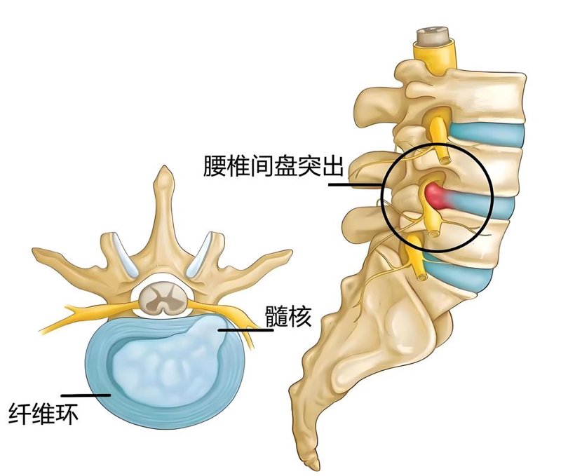 腰椎病