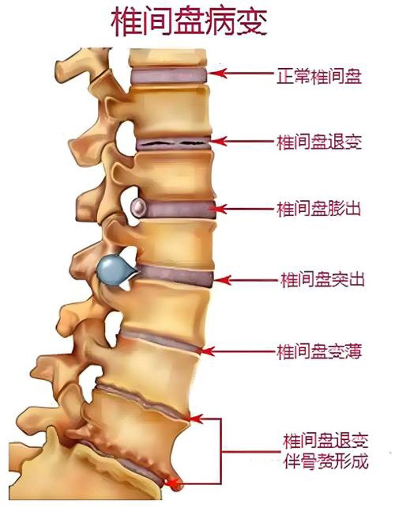 颈椎病：现代社会的隐形杀手